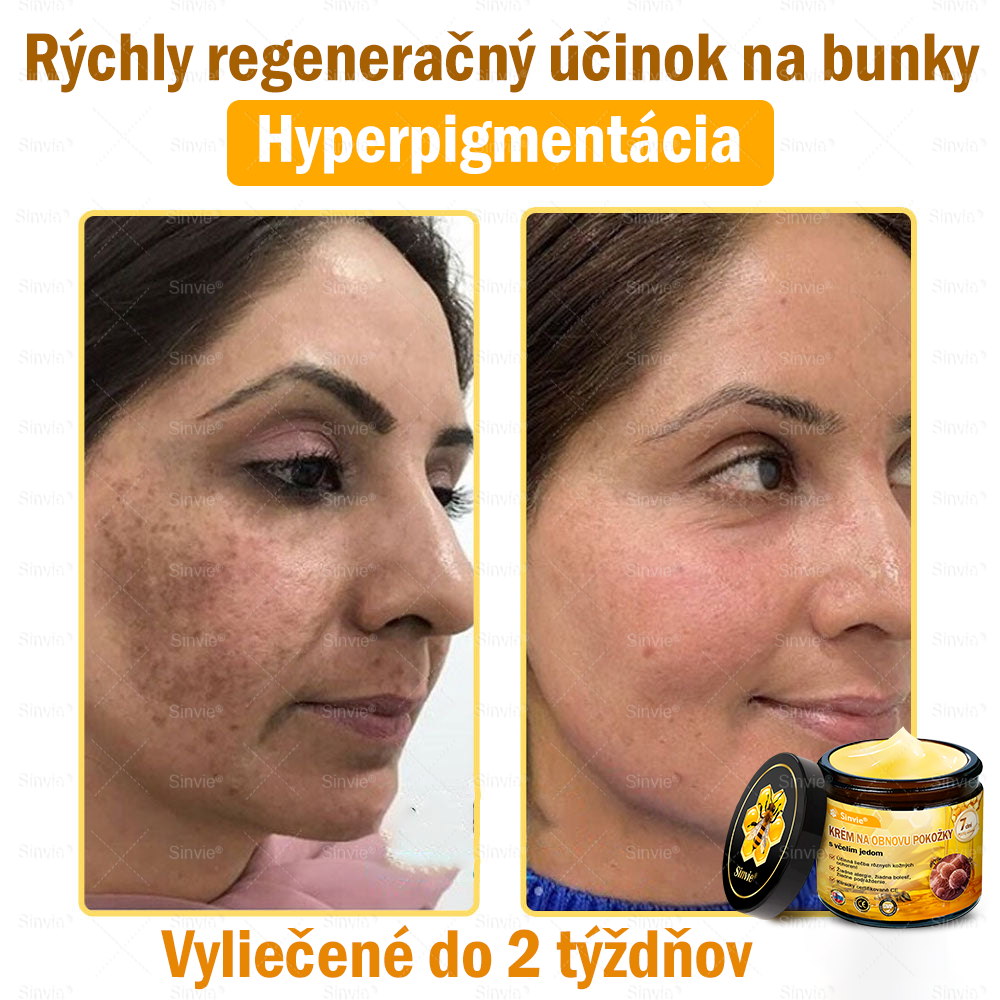 ✨Sinvie® Krém na obnovu pokožky s včelím jedom 🔥 Odporúčané dermatológmi | Proti vráskam, pigmentovým škvrnám a ochabnutej pokožke – 50 ml