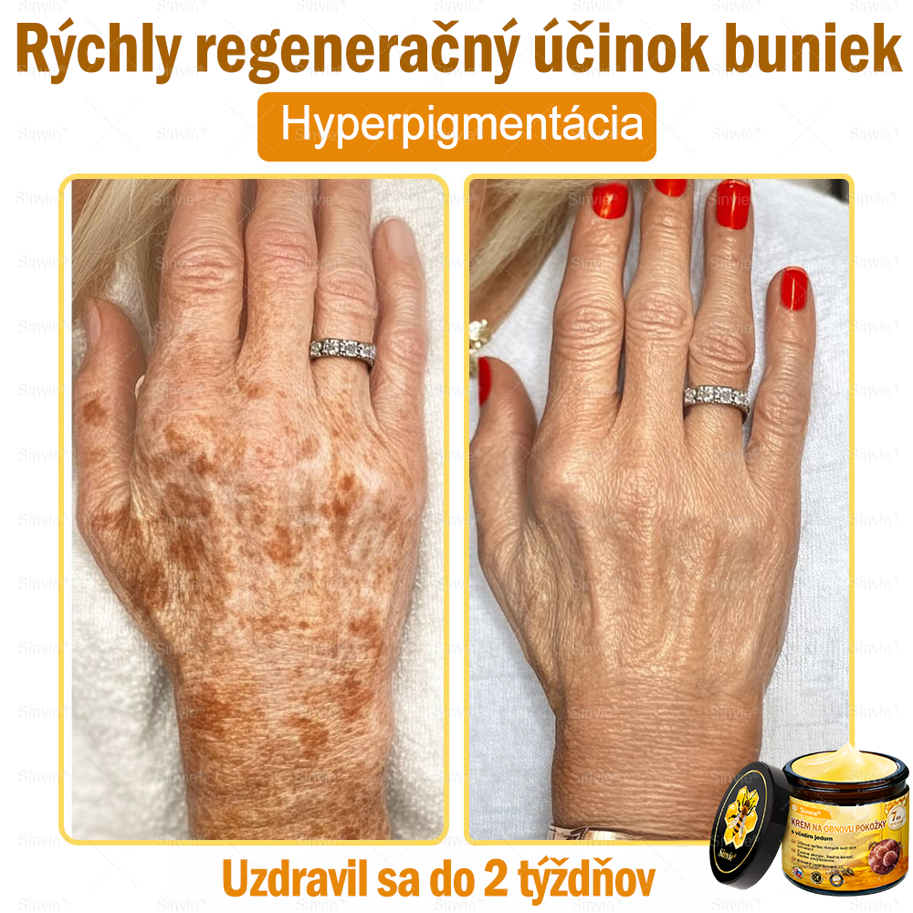 ✨Sinvie® Krém na obnovu pokožky s včelím jedom 🔥 Odporúčané dermatológmi | Proti vráskam, pigmentovým škvrnám a ochabnutej pokožke – 50 ml