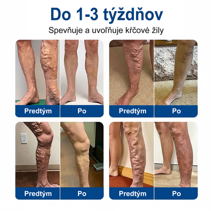 🔥Medistart® VeinRepair – mikrotűs ápoló tapasz ⚡ Azonnali megkönnyebbülés, hosszan tartó eredmény