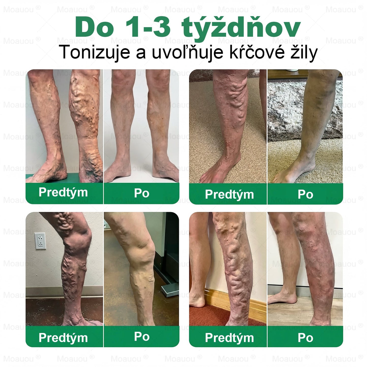 👨‍⚕️✅Moauou® Cieľová Mikronedlová Náplasť na žily⚡Okamžitá úľava, dlhodobé výsledky – veľký výpredaj